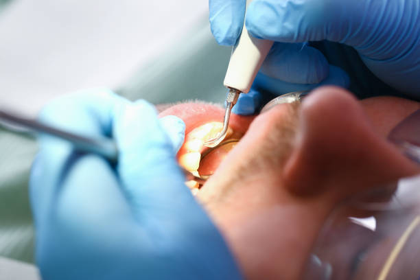 Best Dentist for Tooth Abscess  in Castle Hills, TX