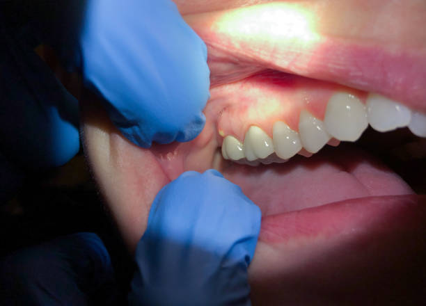 Best Chipped Tooth Repair Near Me  in Castle Hills, TX